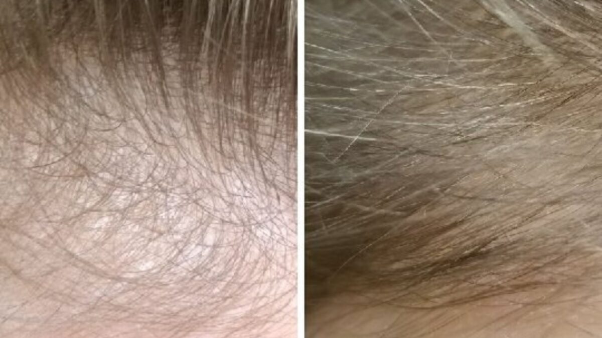 What is the Main Cause of Hair Loss?  The #1 surprising thing you’ve never heard